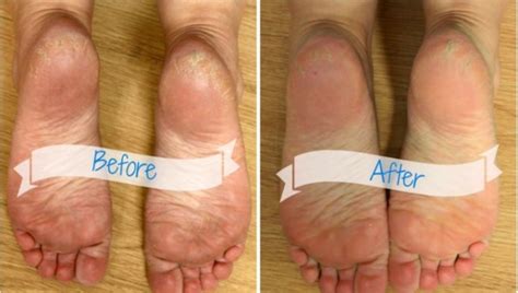 How To Remove Dead Skin On Feet Naturally At Home