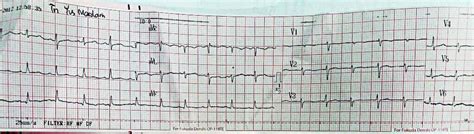 Electrical alternans patterns on ECG. | Download Scientific Diagram