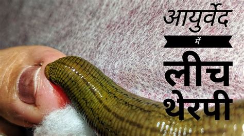 Leech Therapy In Ayurveda Hindi आयुर्वेद की लीच थेरपी हिंदी में Drpys