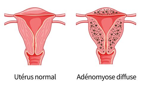 Adénomyose causes symptômes et traitements