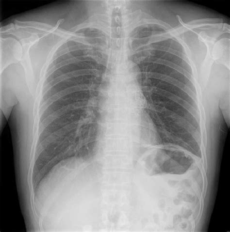 Chest X Ray Showing Mediastinal Calcification Download Scientific Diagram