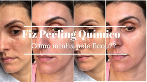 PEELING QUÍMICO MINHA EXPERIÊNCIA ANTES E DEPOIS Nati Nahas YouTube