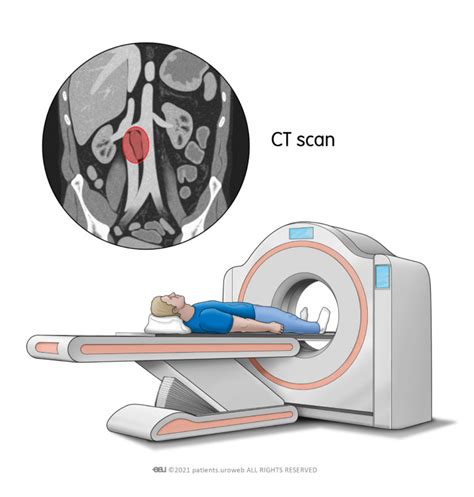 Know everything about Prostate cancer - Patient Information