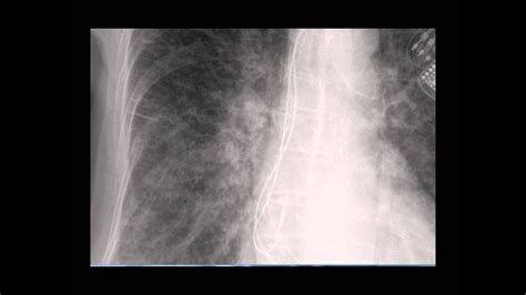 Chest x-ray -- Difference between Kerley B lines and blood vessels - YouTube