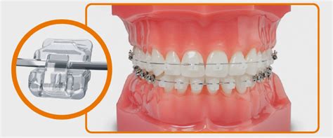 Cl Nica Dental Y De Ortodoncia Sousa Lennox Brackets Autoligados