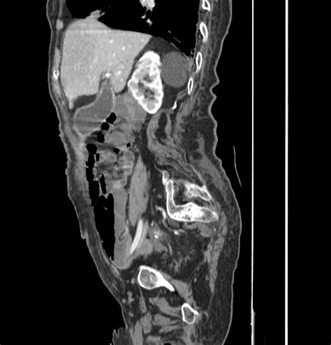 Spontaneous Cholecystocutaneous Fistula Image Radiopaedia Org