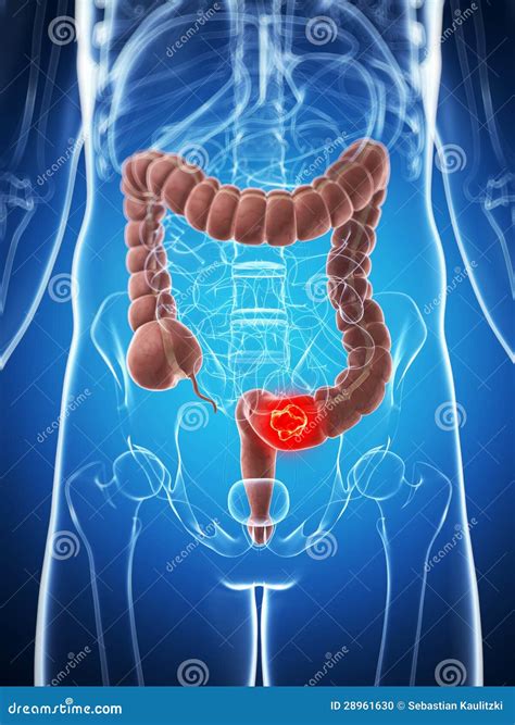 Male Colon Cancer Stock Illustration Illustration Of Highlight