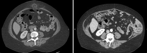 Linea Semilunaris Injury. Axial CT of a patient who underwent attempted ...