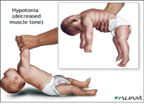 Current Aspects Of Clinical Genetic Diagnosis In Werdnig Hoffman Spinal