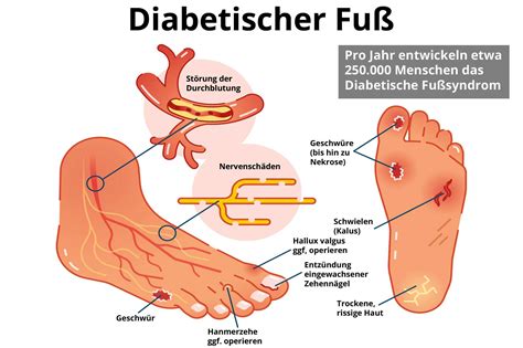 Diabetischer Fu