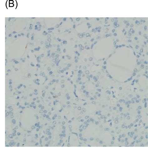 Ck Expression In Minimally Invasive Follicular Thyroid Carcinoma A