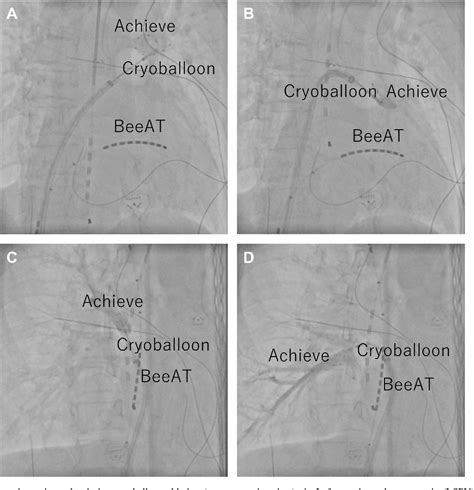 Figure 2 From Removing Pericardial Drainage Tube For Acute Cardiac