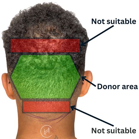 What Is The Overharvested Donor Area In Hair Transplant