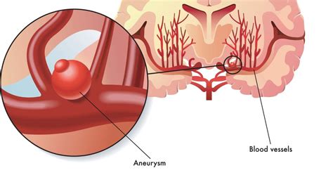 Anevrism Cerebral Cauze Simptome I Tratament Replicaonline Ro