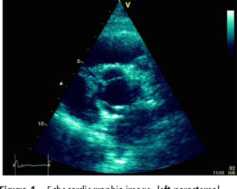 Figure 1 From Quadricuspid Aortic Valve With Aortic Regurgitation A