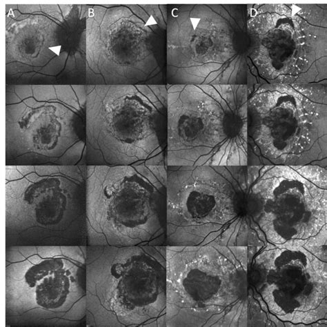 Classification Of Retinopathy Of Prematurity ROP According To Zone