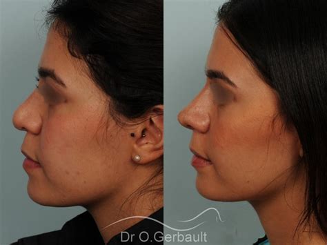 Rhinoplastie avant après photos et exemples de nez refaits