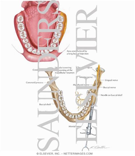 Long Buccal Nerve Block