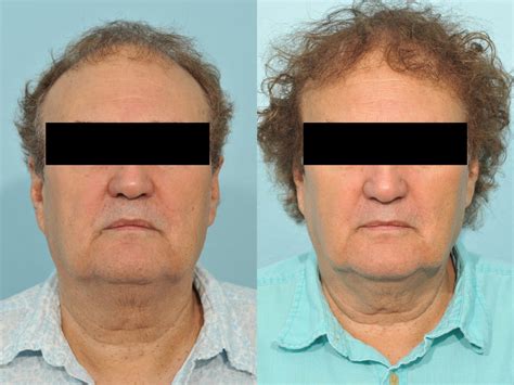 Hair Transplant Before And After 5 Jesse E Smith Md Facs Ft Worth