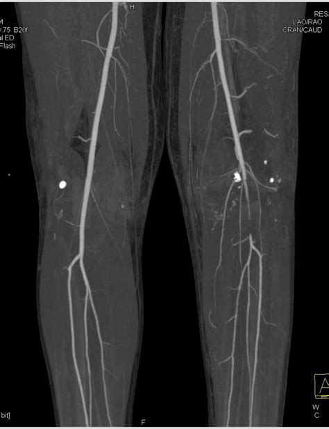 Occlusion of the Left Popliteal Artery - Trauma Case Studies - CTisus ...