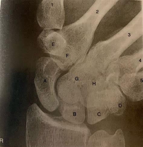 Carpal X-rays Flashcards | Quizlet
