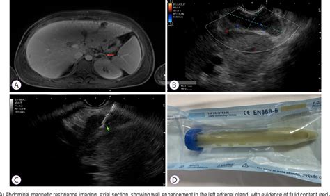 Figure 1 From Endoscopic Ultrasound Guided Transgastric Puncture And