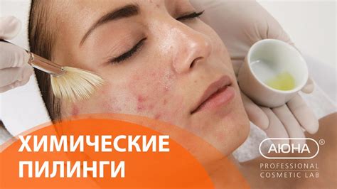 Вопрос эксперту: ХИМИЧЕСКИЕ ПИЛИНГИ - YouTube