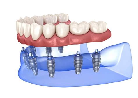 Dental Implant Types And Classification at Herbert Mcwhorter blog