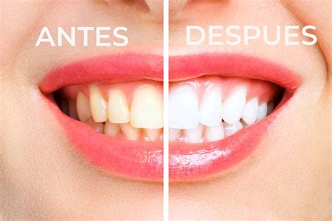 Tratamiento Blanqueamiento Dental y Consejos Clínica Esther Aparicio