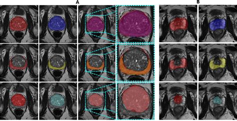 Figure 2 From Automatic Prostate And Prostate Zones Segmentation Of