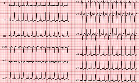 Cardio Fr Atrioventricular Tachycardia Utilising An Accessory Pathway