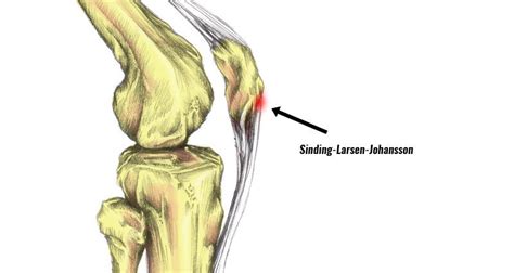 Sinding Larsen Johansson Syndrome Symptoms Causes Treatment