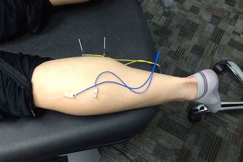 Dry Needling Therapy With Electrical Stimulation