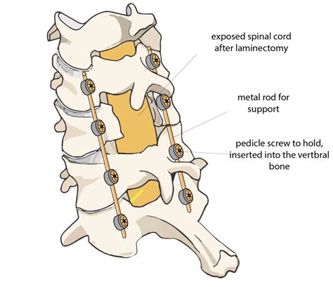 Spinal Fusion Rajiv Bajekal