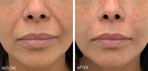 Nasolabial Fold Filler Simply Clinics