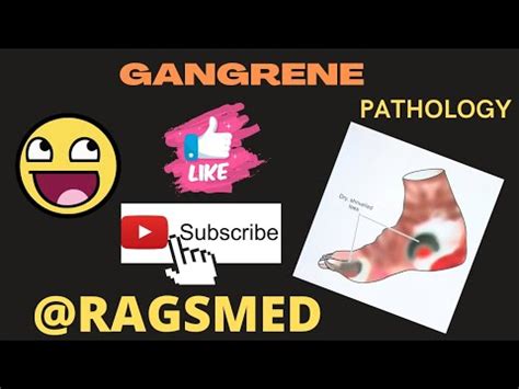 Gangrene Cell Injury Pathology Ragsmed Youtube