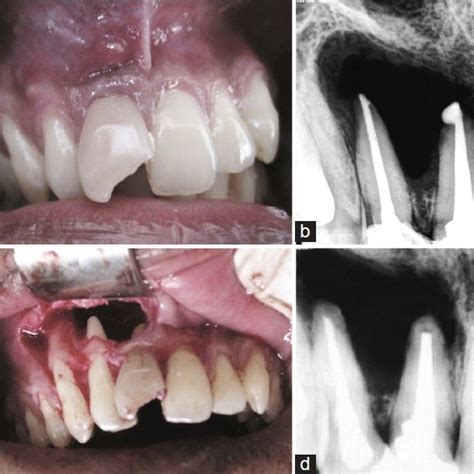 Pdf Management Of A Large Periapical Lesion Using Biodentinetm As