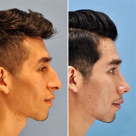 World Renowned Rhinoplasty Surgeon Brings Expertise To Manhattan