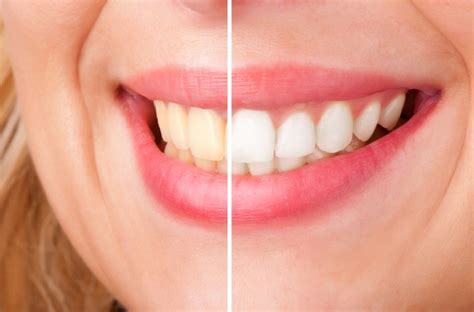 Sbiancamento Denti Con Laser Che Cos E Come Funziona