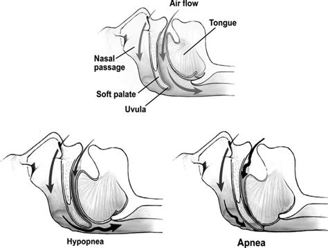 Apnea Vs Hypopnea Events Per Hour Explained Apnea Sleep Problems