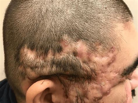 Hidradenitis Suppurativa Dissecting Cellulitis Of The Scalp Acne