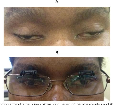 Figure 39 From A Modular And Adjustable Ptosis Crutch As A Non Surgical