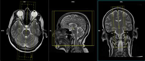 Cerebrospinal fluid flow MRI | CSF flow MRI protocol and planning