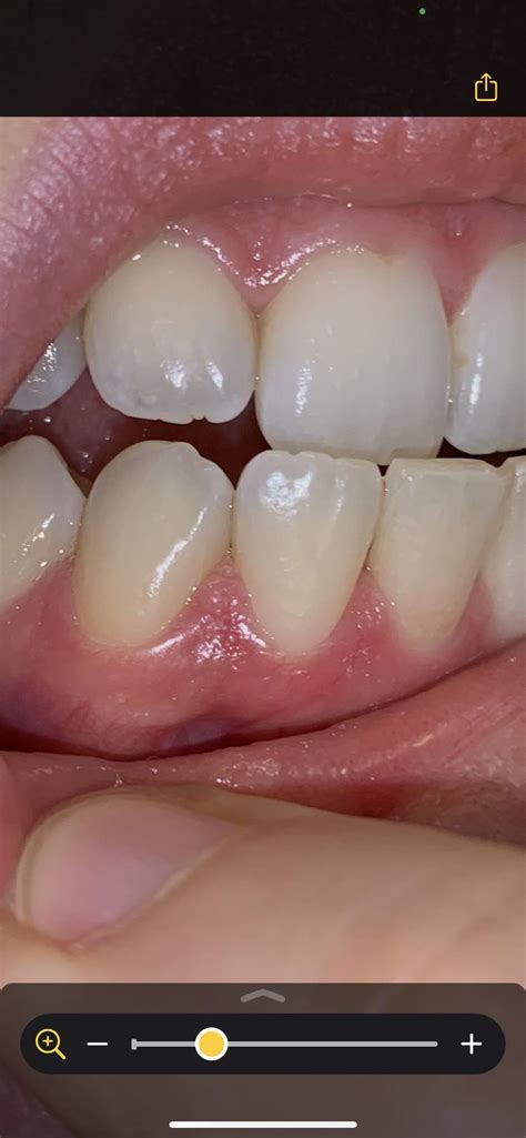 Is This Oral Hpv Or Just Normal Gums I Have Warts On Other Places And Have Been Hyper Vigilant