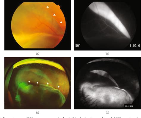 PDF Retinal Pigment Epithelial Tears After Ex PRESS Filtration