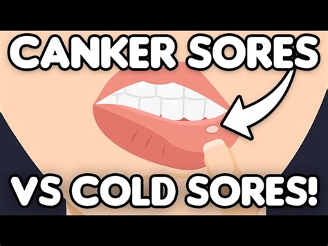 Canker Sore Vs Cold Sore Inside Lip