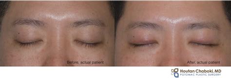 Upper Eyelid Surgery In Asian Patients To Create A Fold Incision Or Suture Technique