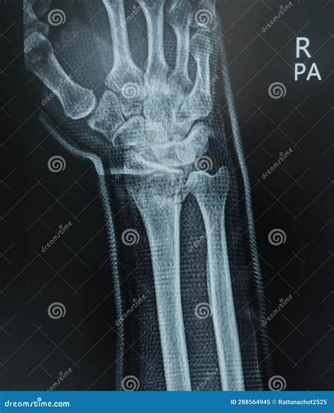 Comminuted Fracture X Ray