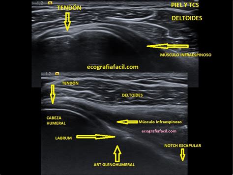 Articulación Ecografía Fácil