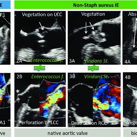 Of Infectious Endocarditis And Specific Findings On Echocardiography Download Scientific Diagram